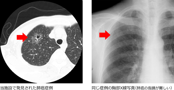 肺_CT検査 肺_CT検査